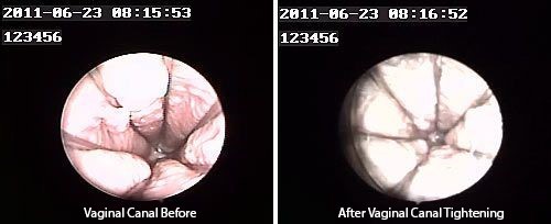hemac-aesthetic-skin-vaginal-tightening3